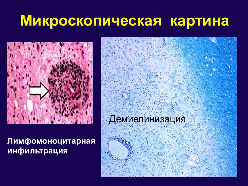 Демиелинизирующие заболевания презентация