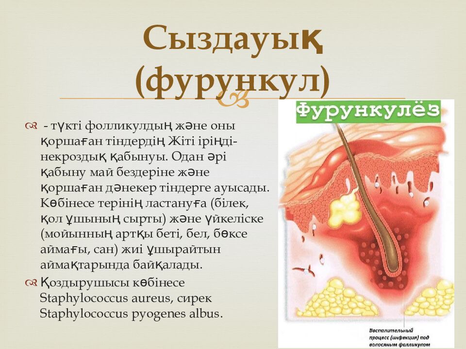 Сыздауық (фурункул)