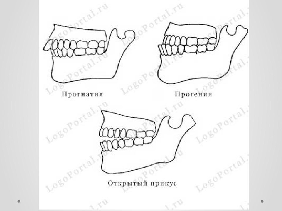 Прогения и прогнатия картинки