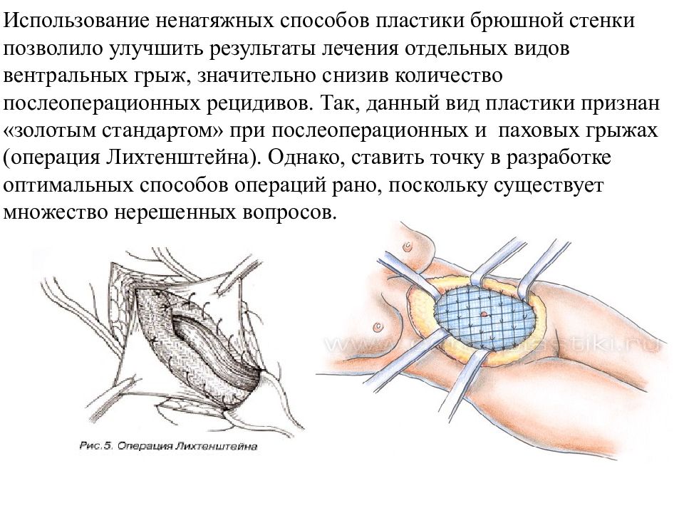 Ущемленная паховая грыжа статус локалис карта смп