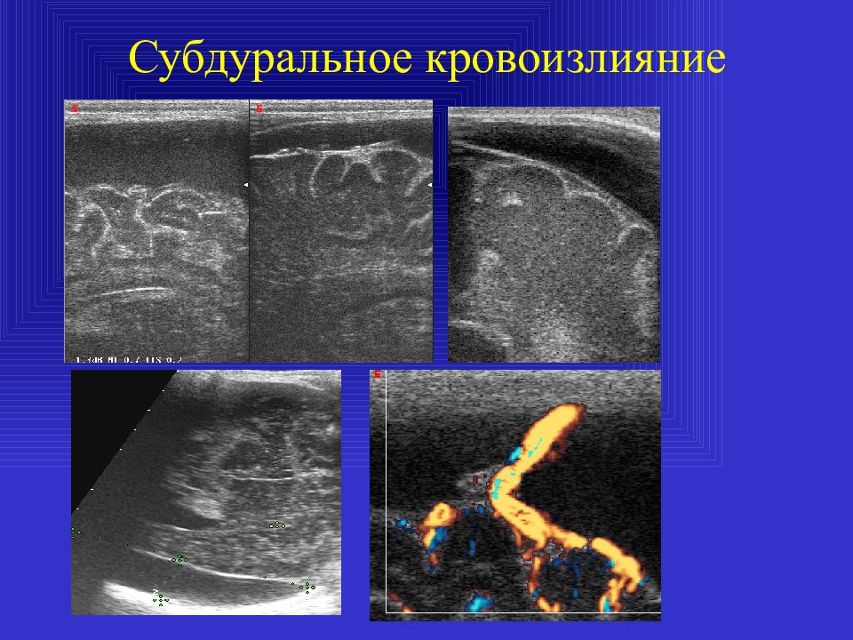 Субдуральное кровоизлияние это. Субдуральная гематома НСГ. Субдуральное и субарахноидальное кровоизлияние. Субдуральная гематома на УЗИ. Субарахноидальное кровоизлияние на УЗИ.