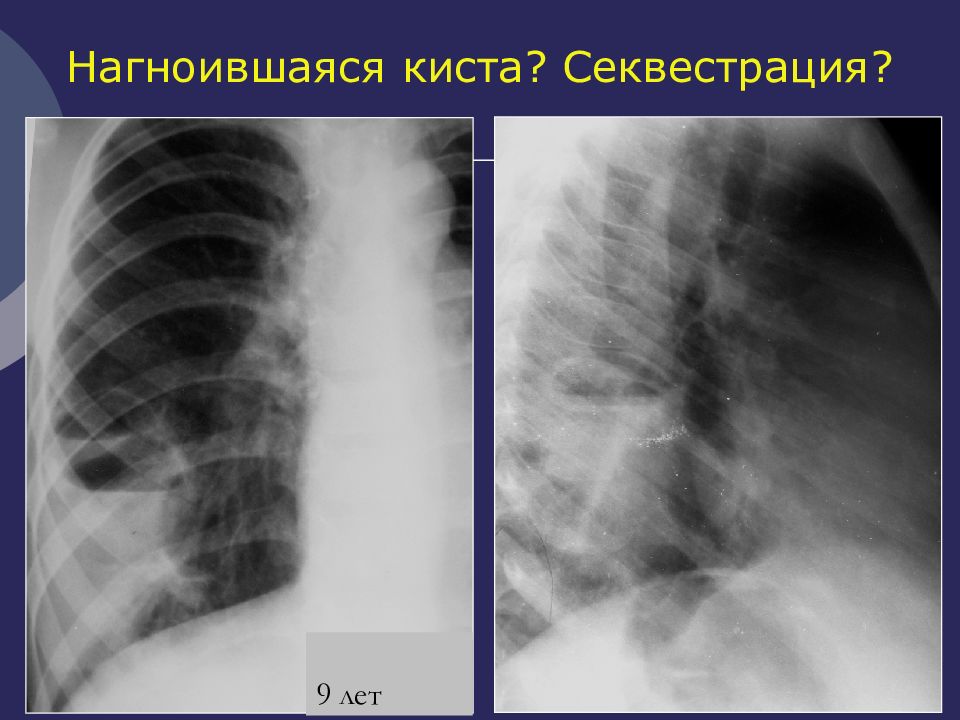 Легочная секвестрация рентген. Абсцесс легкого с секвестрацией и без. Врожденная секвестрация легкого.