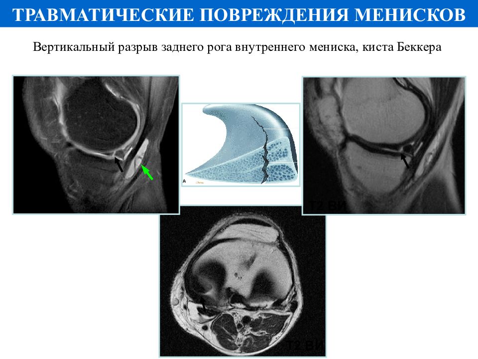 Дегенеративные изменения менисков это. Классификация повреждения менисков по Stoller. Степени разрыва мениска по Stoller на мрт. Задний Рог мениска повреждение 2 степени.