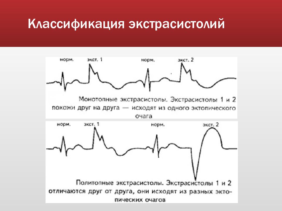 Желудочковая экстрасистолия презентация