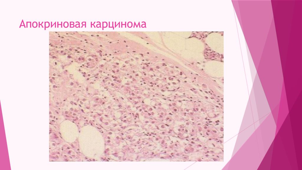 Карцинома молочной. Апокриновая карцинома. Апокриновая карцинома молочной железы. Метапластическая карцинома. Карцинома с апокриновой дифференцировкой.