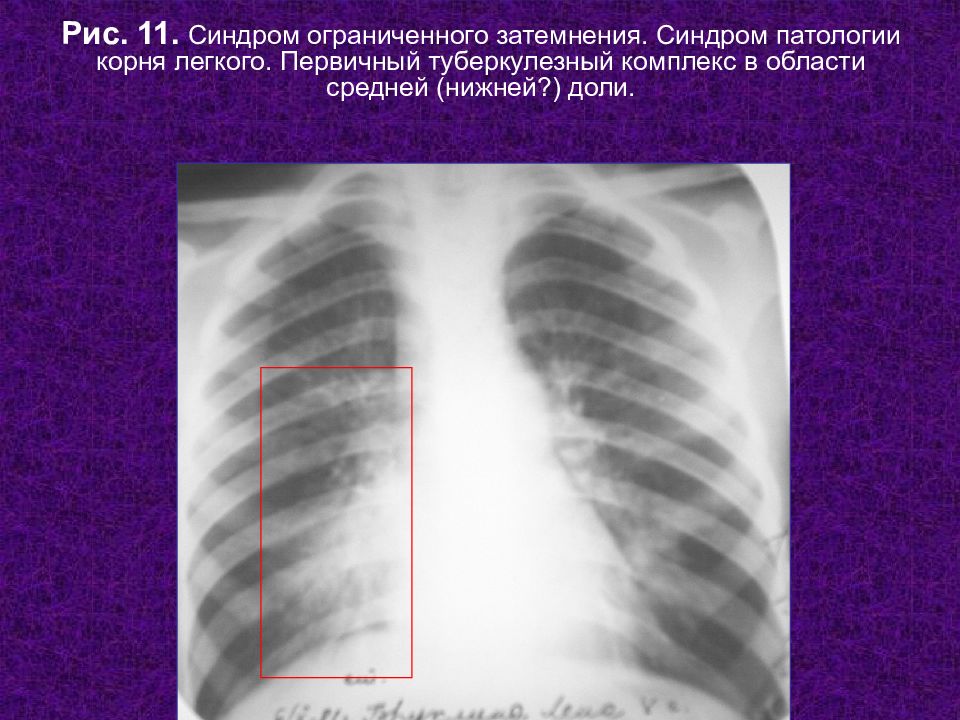 Затемнение в легких