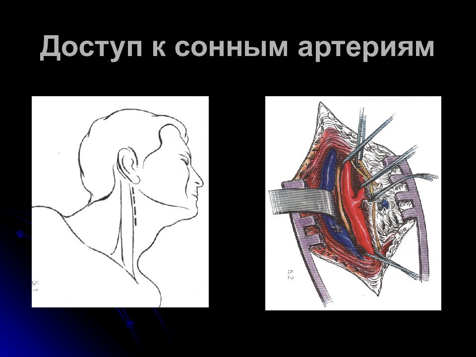 Опасность сонной артерии