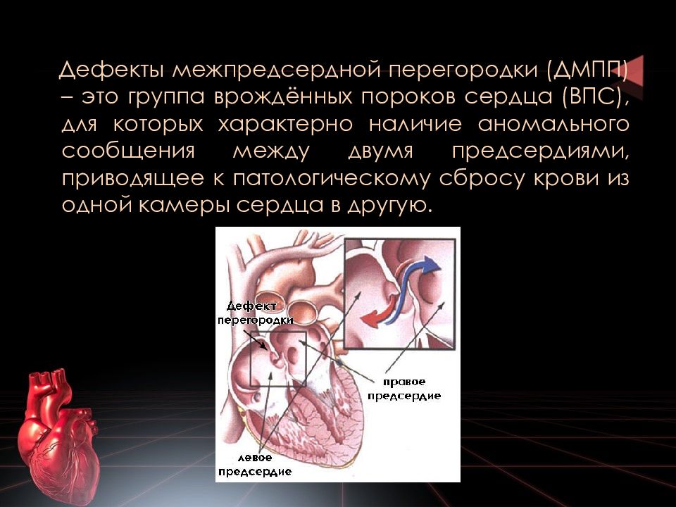 Дефект межпредсердной