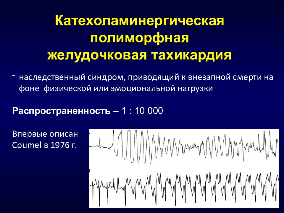 Желудочковая тахикардия лечение. Катехоламинергическая полиморфная желудочковая тахикардия. Веретенообразная желудочковая тахикардия ЭКГ. Полиморфная желудочковая тахикардия ЭКГ. Пароксизмальная полиморфная желудочковая тахикардия на ЭКГ.