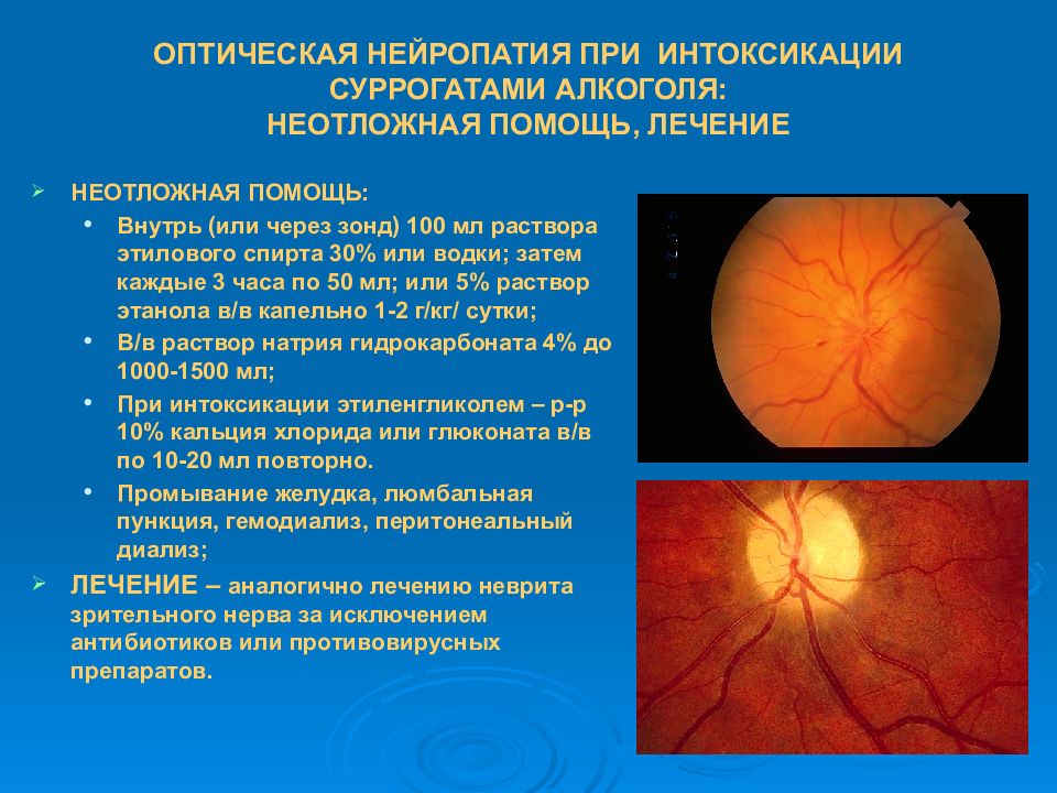 Нейропатия слева. Атрофия зрительного нерва Лебера. Наследственная оптическая нейропатия Лебера. Ишемическая невропатия зрительного нерва. Ишемическая нейрооптикопатия зрительного нерва.