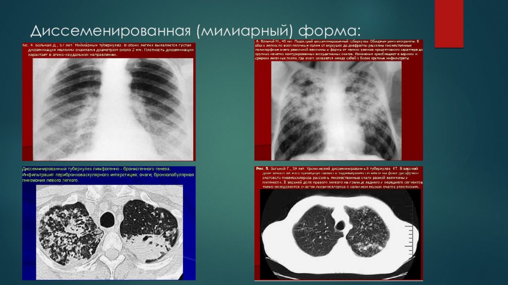 Кт картина туберкулеза легких