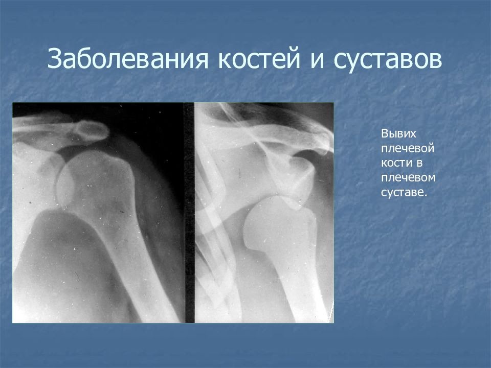 Болезнь костей. Остеопороз плечевого сустава рентген. Заболевание костей и суставов.