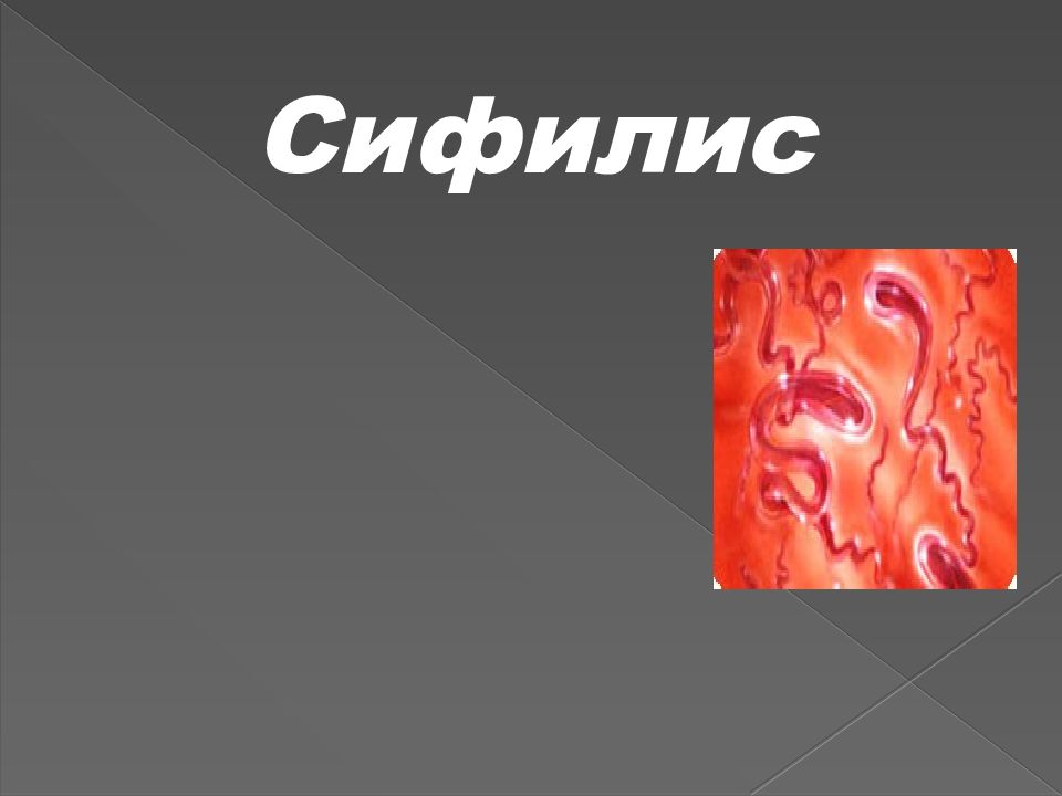 Сифилис