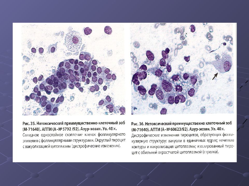 Цитологическая диагностика заболеваний молочной железы презентация