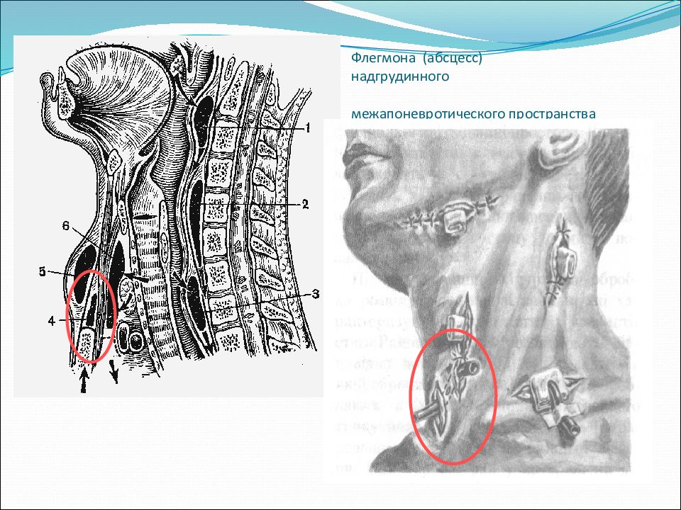 Вскрытие флегмоны шеи. Топографическая анатомия и Оперативная хирургия шеи. Топографическая анатомия абсцессы шеи. Флегмона надгрудинного клетчаточного пространства. Абсцесс заглоточного пространства.