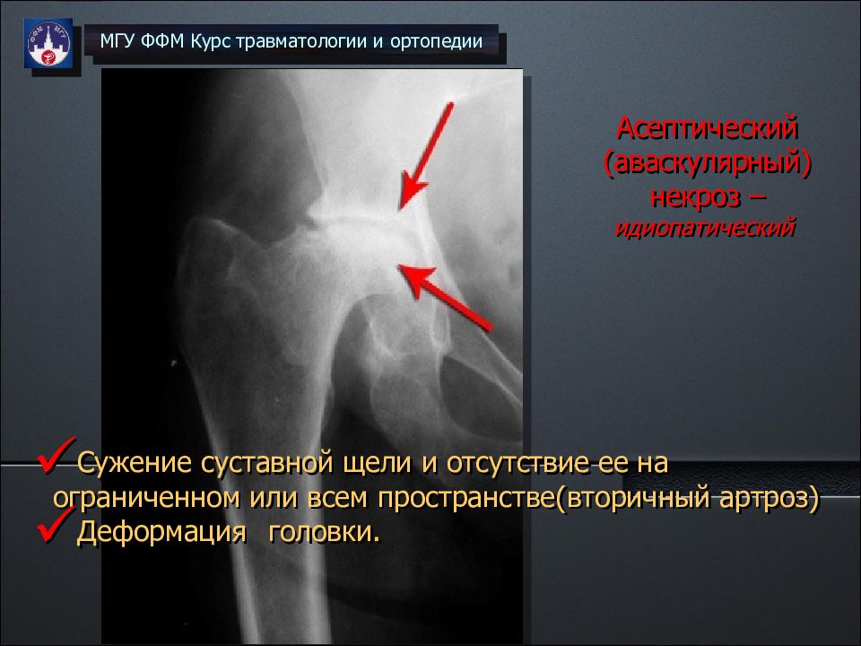 Некроз мыщелков. Асептический некроз бедренных костей. Асептический некроз коленного сустава рентген. Асептический некроз коленного кости. Асептический некроз медиального мыщелка.
