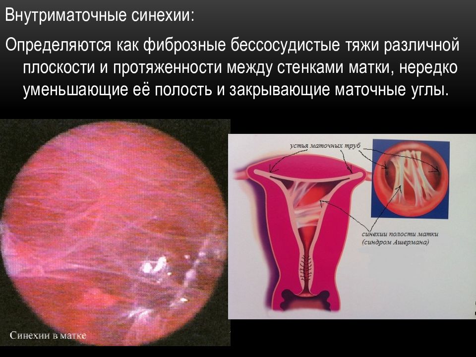 Синехии в полости матки что это. Внутриматочные спайки синехии. Внутриматочные синехии (синдром Ашермана). Синдром Ашермана гистероскопия.