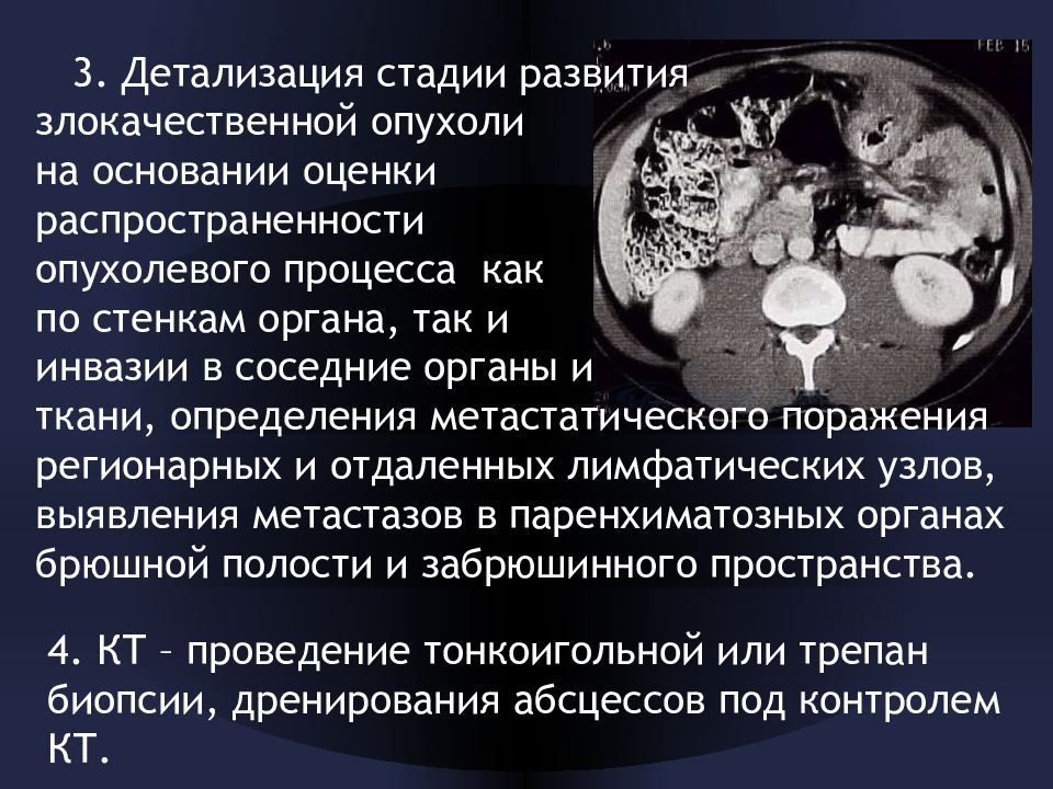 Злокачественные опухоли лучевая диагностика. Стадии развития опухоли. Стадии развития опухолевого процесса. Стадии развития злокачественных опухолей. Процесс развития злокачественной опухоли это.