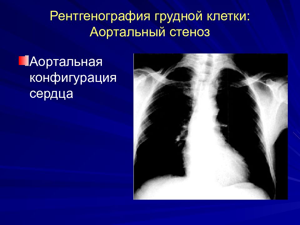 Рентгенография сердца. Митральная конфигурация сердца рентген. Аортальная конфигурация сердца рентген. Описание аортальной конфигурации сердца рентген. Аортальный стеноз рентген.