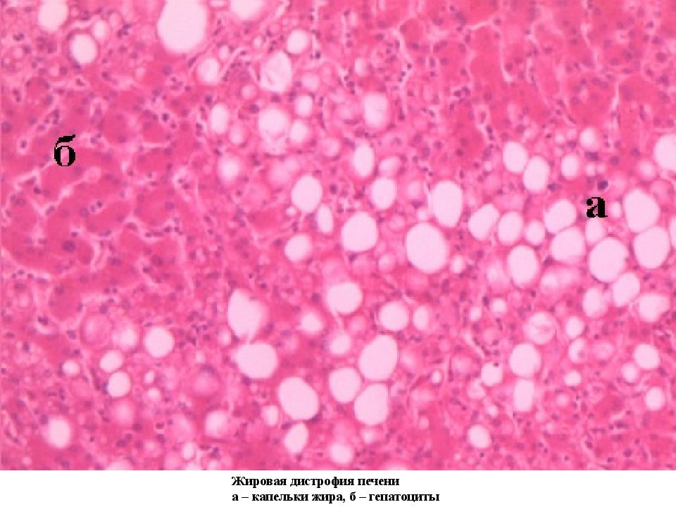 Жировая дистрофия печени рисунок микропрепарат