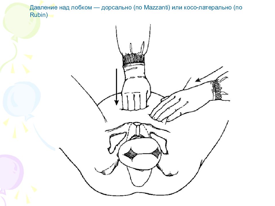 Дистоция плечиков презентация