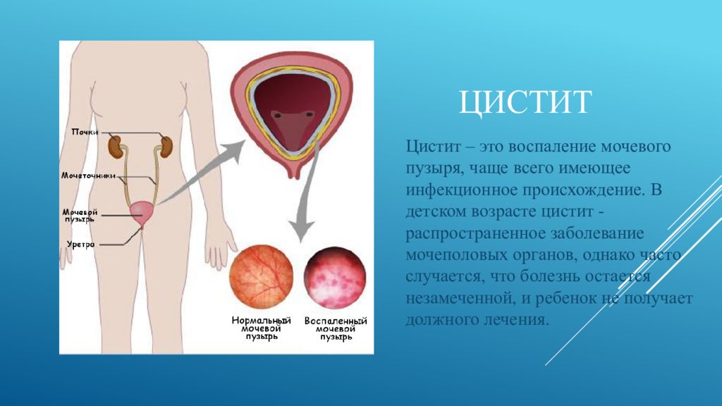 Воспаление мочевого симптомы. Заболевание мочеполовой системы цистит это. Заболевания органов мочевыделения цистит. Презентация на тему цистит. Заболевания мочевого пузыря у детей.