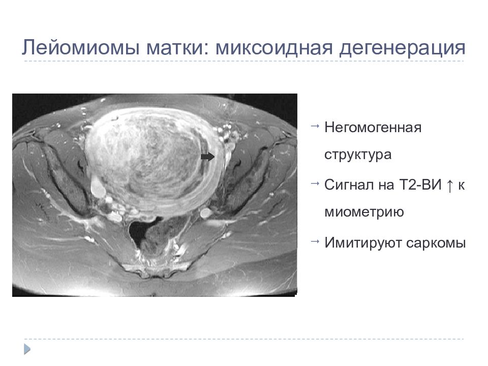 Миксоидная лейомиомы. Гиалиновая дегенерация миомы. Миксоидная дегенерация миомы на мрт. Гиалиновая дегенерация миомы мрт.