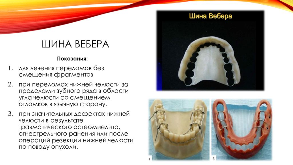 Методы временной и постоянной иммобилизации отломков челюстей презентация