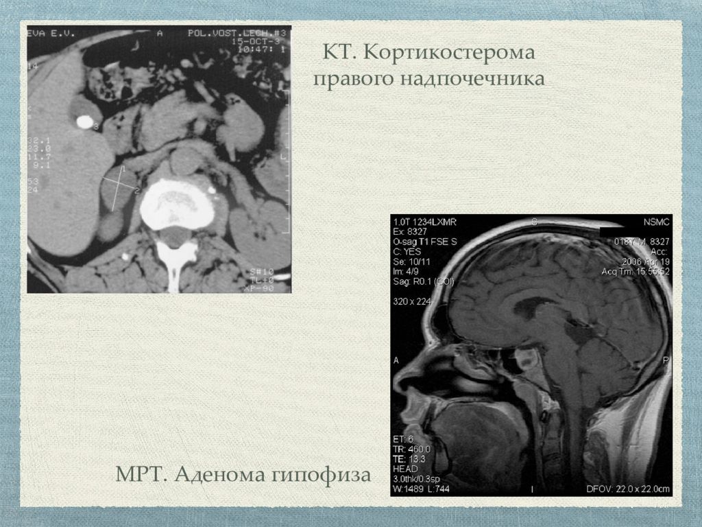 Характерная картина данных компьютерной томографии надпочечников при болезни иценко кушинга