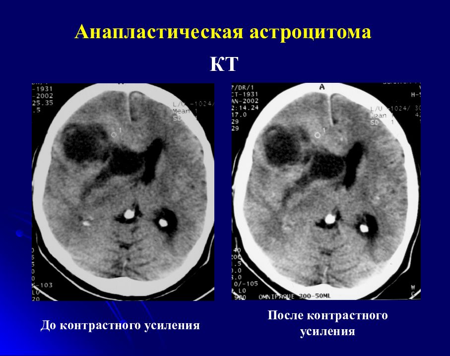 Астроцитома грейд. Астроцитома головного мозга кт. Злокачественная астроцитома гистология. Астроцитома головного мозга гистология.