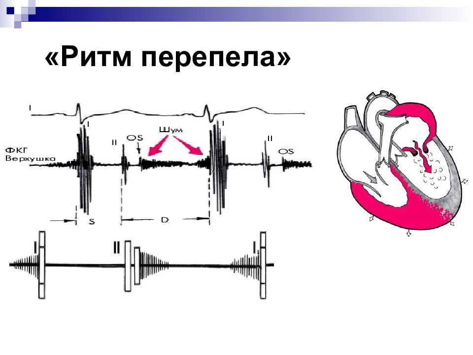 Аускультативная картина при митральном стенозе сердца включает тест