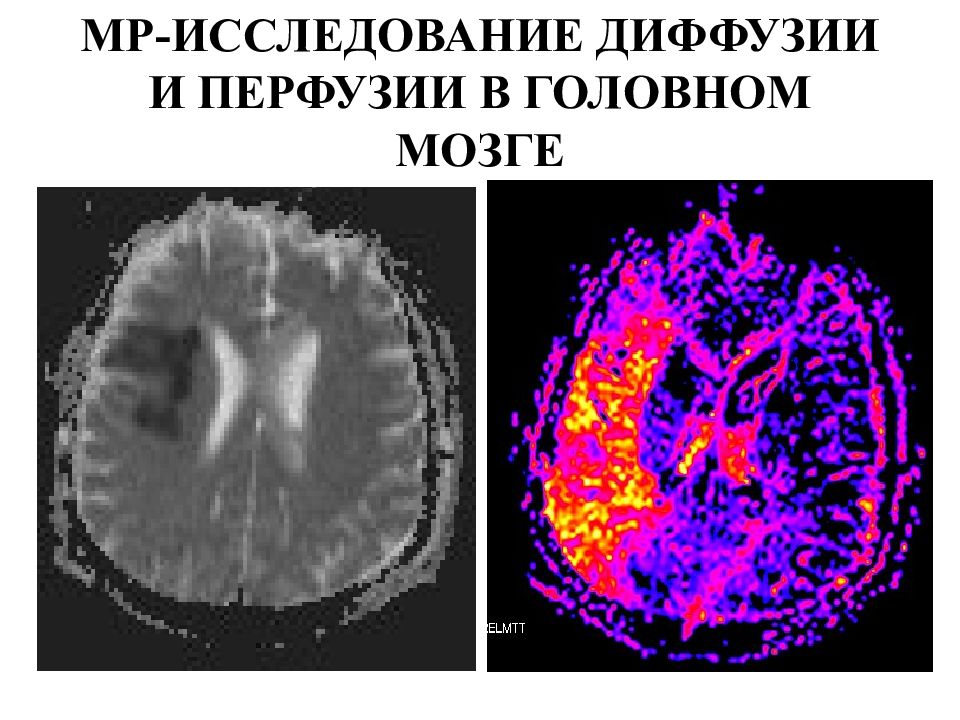 Диффузия и перфузия. Пилоцитарная астроцитома мозжечка кт. Пилоцитарная астроцитома гистология. Астроцитома головного мозга мрт.