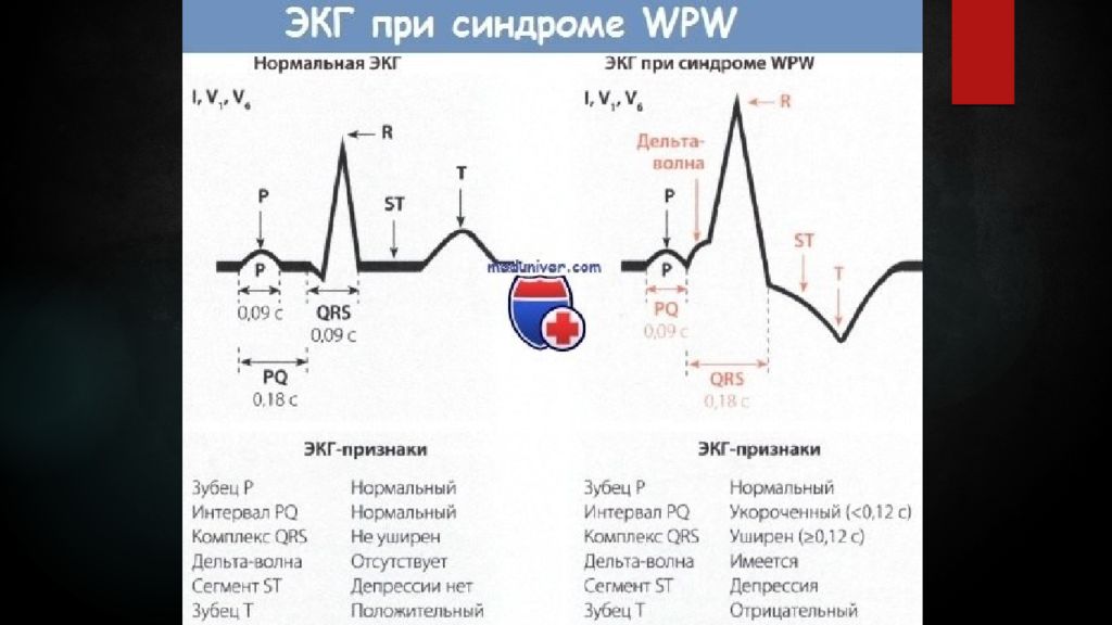 Карта вызова смп брадиаритмия