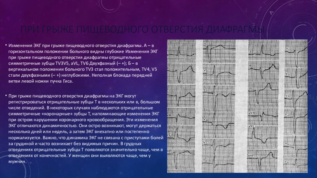 Изменения на экг. Грыжа пищеводного отверстия диафрагмы на ЭКГ. ЭКГ при грыже пищеводного отверстия диафрагмы. Изменения ЭКГ при грыже пищеводного отверстия диафрагмы. Изменения на ЭКГ при грыже пищеводного отверстия.