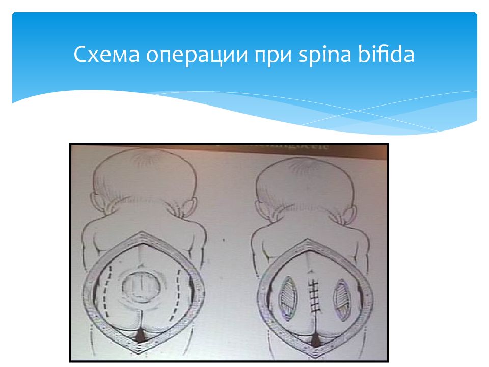 Фетальная хирургия. Внутриутробная хирургия плода. Spina Bifida внутриутробная операция. Внутриутробная коррекция spina Bifida. Фетальная хирургия внутриутробная хирургия.