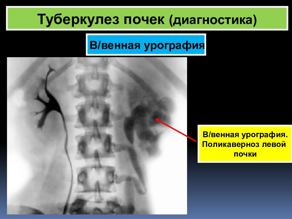 Диагностика почек. Туберкулез почки диагноз. Туберкулез почки рентген. Нефротуберкулез рентген.