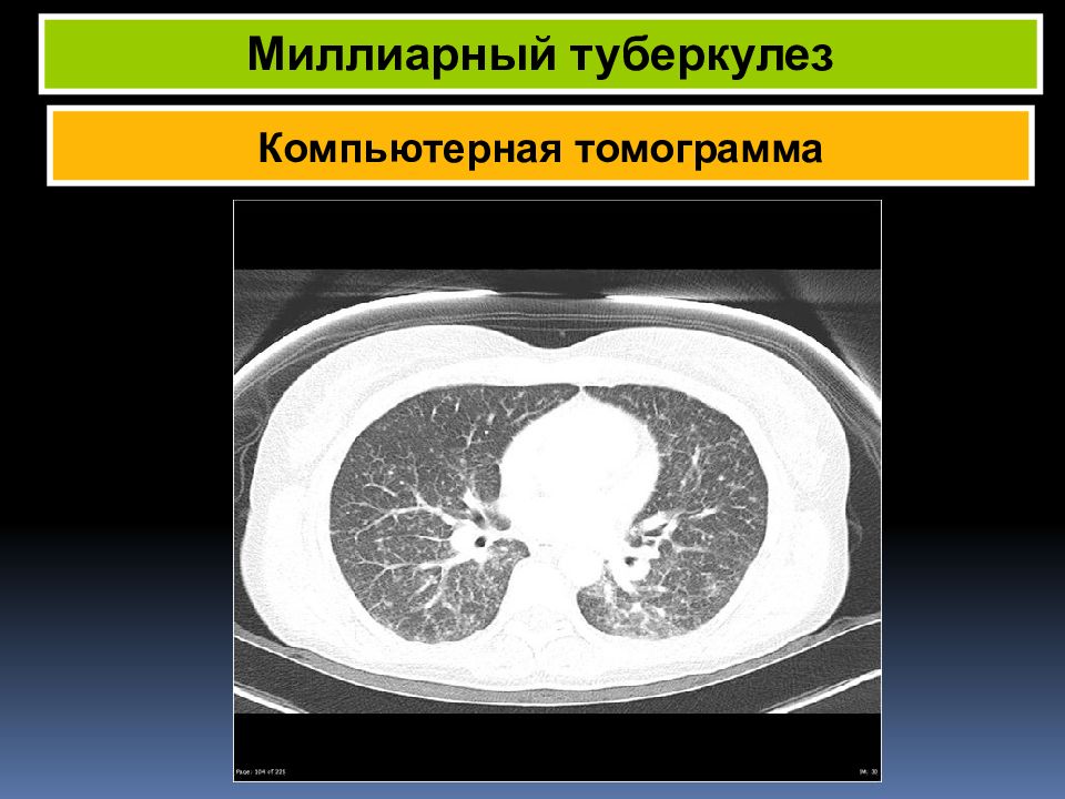 Очаги на кт легких форум. Диссеминированный туберкулез кт. Кавернозный туберкулез кт. Милиарный туберкулез кт.