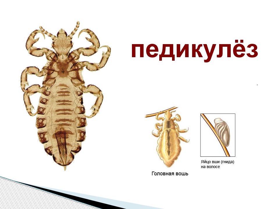 педикулёз