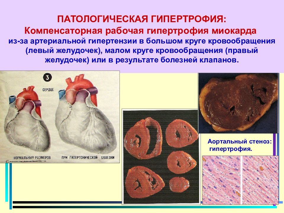 Гипертрофия это. Гипертрофия миокарда исход патологическая анатомия. Рабочая компенсаторная патологическая гипертрофия. Гипертрофия миокарда причины патологическая анатомия. Проявления физиологической гипертрофии миокарда.