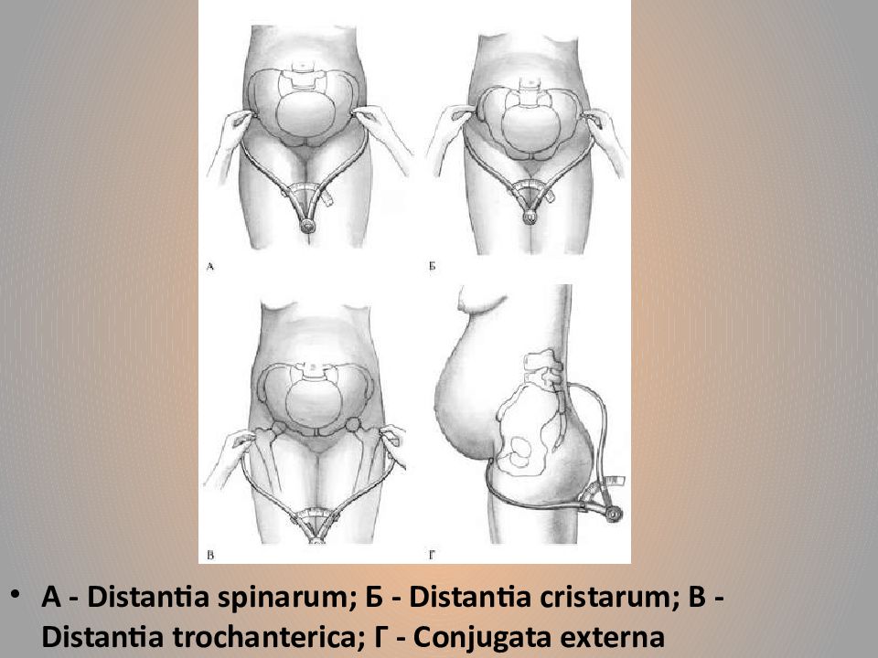 Исследование таза. Измерение размеров таза пельвиометрия. Спинарум кристарум. Distantia cristarum в норме. Измерение наружных размеров таза беременной.