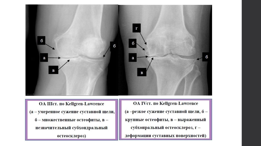 Дегенеративные заболевания суставов презентация