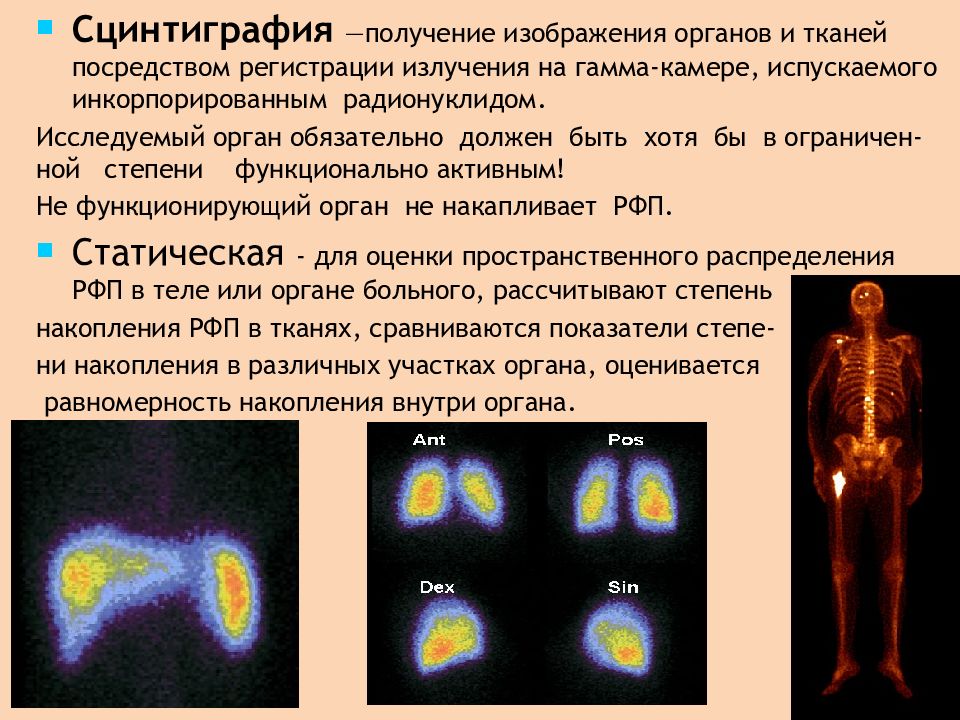 Что такое сцинтиграфия