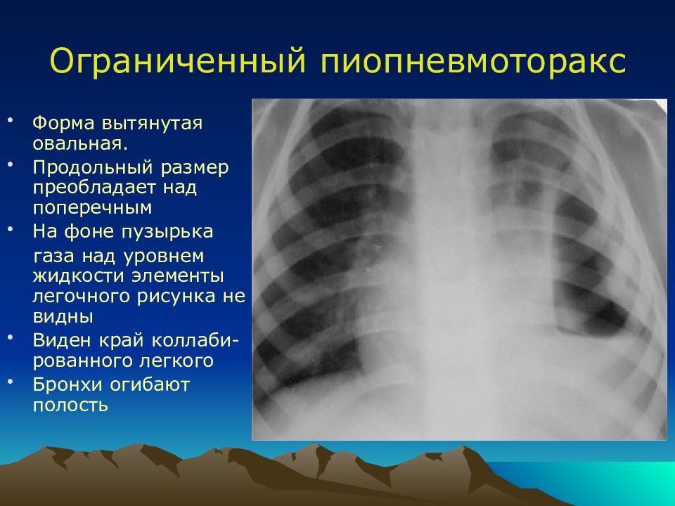 Острая гнойная деструктивная пневмония у детей презентация