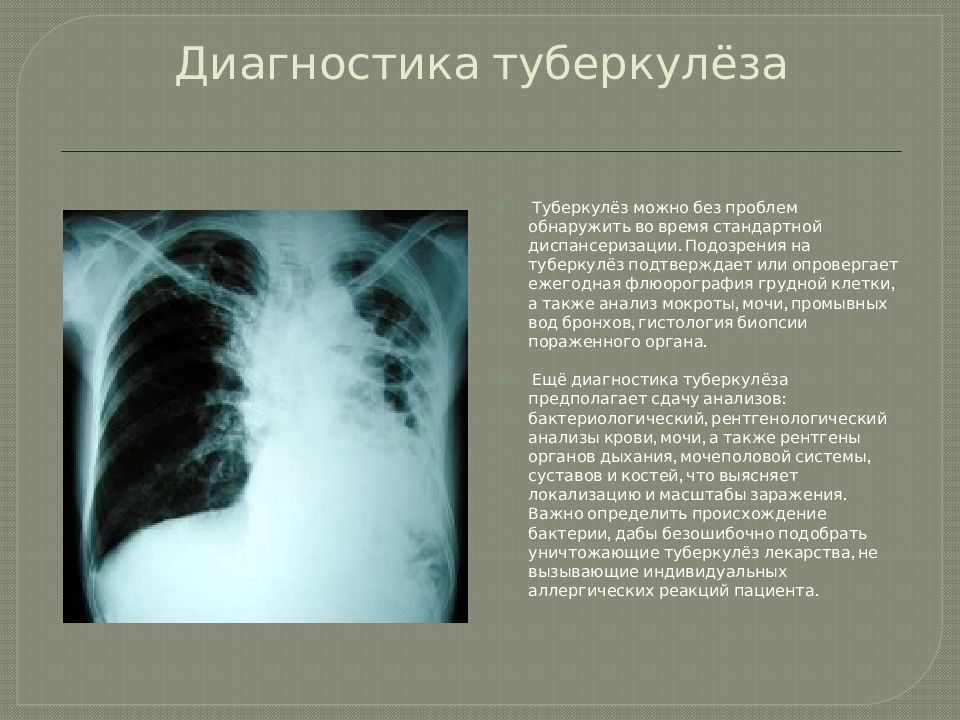 Туберкулез легких симптомы. Диагноз туберкулез. Диагностикатуберкулёза. Выявление туберкулеза.