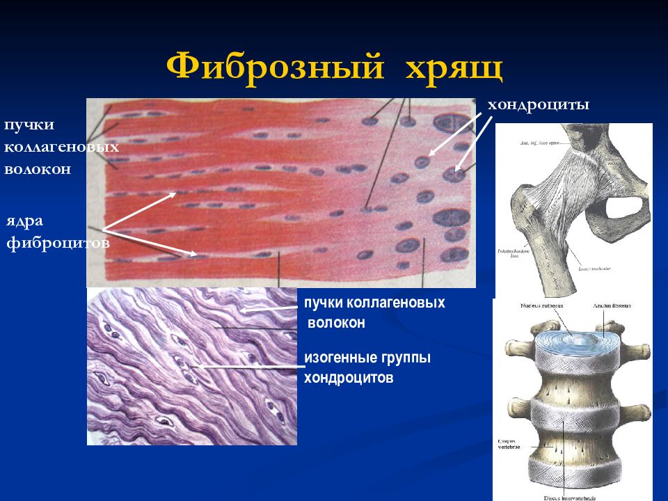 Фибросаркома препарат патанатомия. Фиброзированная ткань. Фиброзный материал. Пальмарный фиброматоз гистология. Фиброзный материал.
