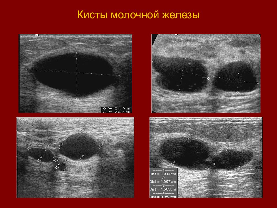 Форум молочная железа. Киста ы молочной железе. Многокамерная киста молочной железы. Коллоидная киста молочной железы.