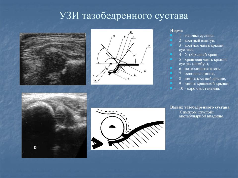 Узи тазобедренного сустава. УЗИ тазобедренных суставов норма. Ультразвуковая анатомия тазобедренного сустава. УЗИ дисплазия тазобедренного сустава показатели. УЗИ анатомия тазобедренного сустава.