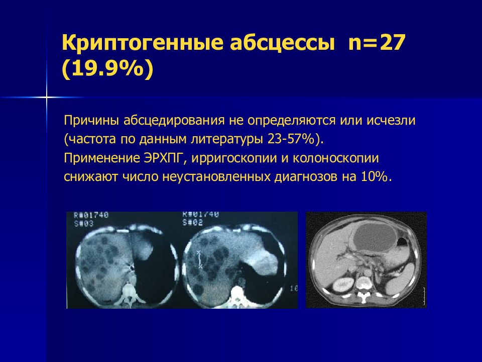 Абсцесс мкб 10. Криптогенные причины. Пилефлебитические абсцессы печени. Криптогенные абсцессы характерны для.