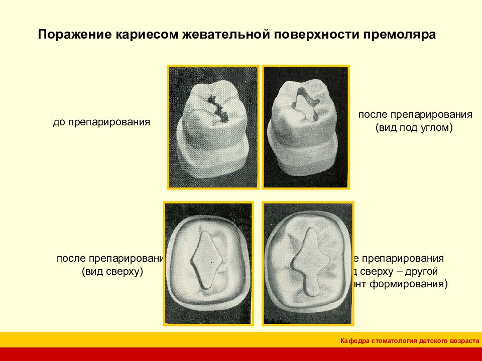 Классификация кариозных полостей по блэку презентация