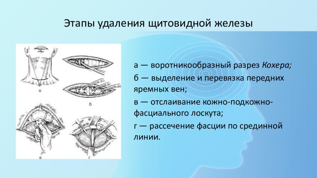 Резекция щитовидной железы. Воротникообразный разрез кохера. Воротникообразным разрезом кокера. Разрез по Кохеру к щитовидной железе. Резекция щитовидной железы этапы.